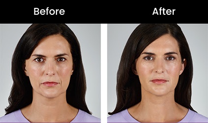 Juvéderm Vollure Facial Dermal Filler| | San Jose Bay Area | Rejuve Medical
